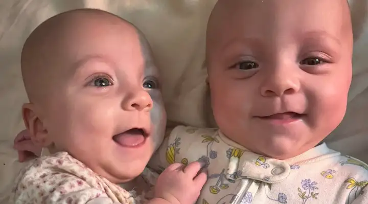 Fiona and Phoebe, rare mono mono twins who celebrated their first birthday after a high-risk pregnancy